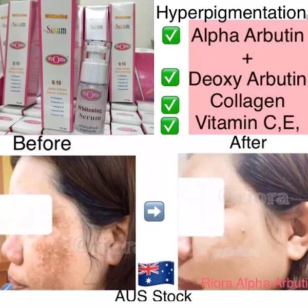 Anti Dark Spot Alpha Arbutin ,collagen & Vit C Serum Hyperpigmentation